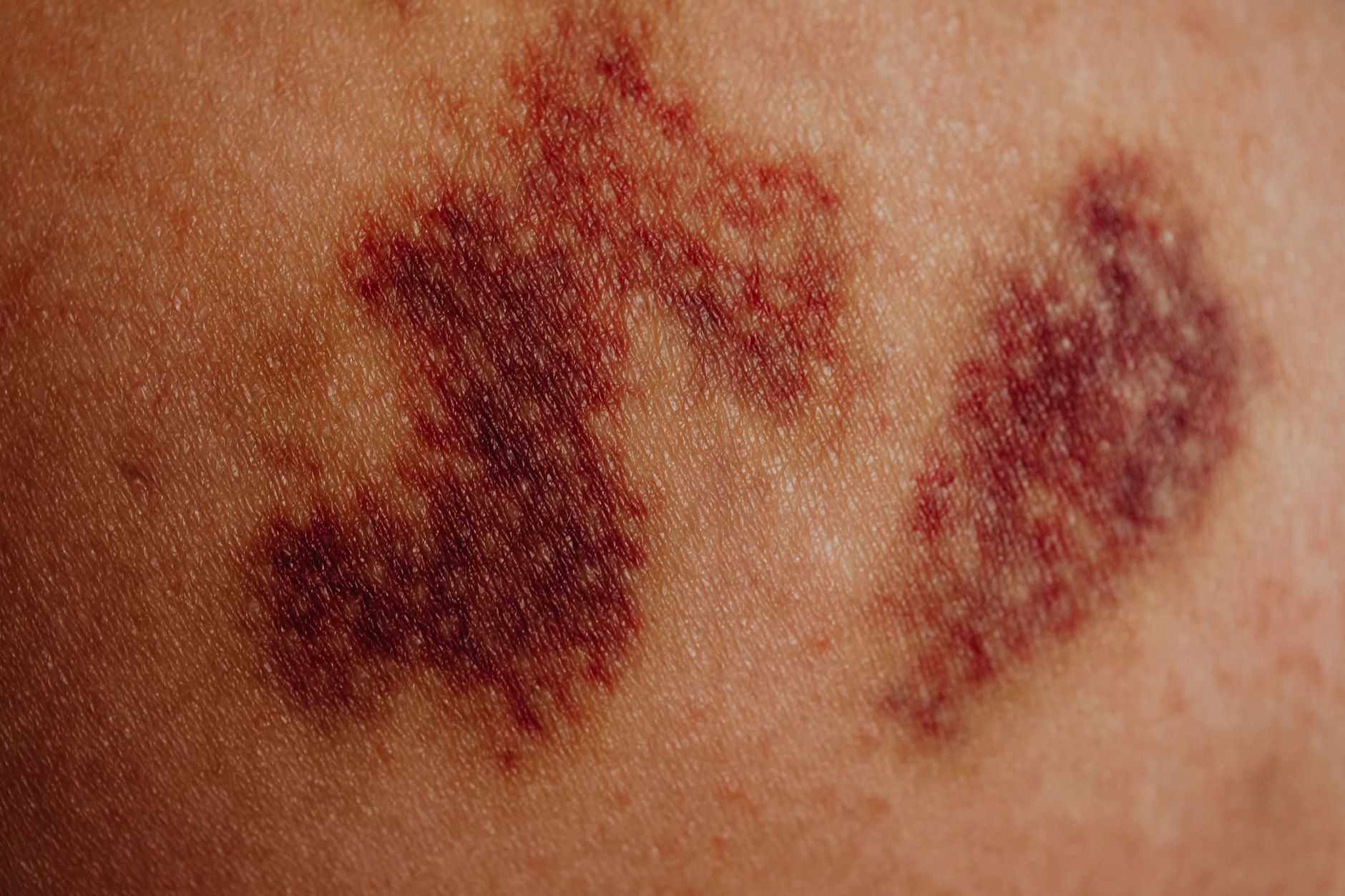 A Bit Bruised, A Bit Bold – Day Two